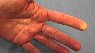 Raynaud's Phenomenon (Reduced Blood Flow) of the FIngertip