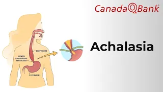 Achalasia