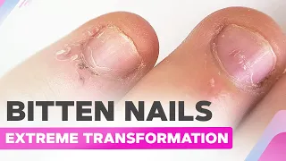 Bitten Nails Extreme Transformation | Acrylic System Nail Extension