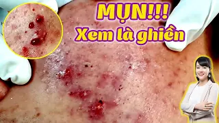 Điều trị mụn viêm, bọc hiệu quả tại TPHCM | Hiền Vân Spa | Acne Treatment |Duy Phương| Part 2| 595