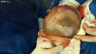 Rare Twin Birth