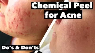 Chemical Peel for Acne Treatment - How to Get Chemical Peel for Acne
