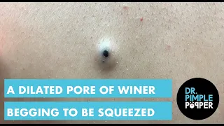 A Dilated Pore of Winer that is Begging to be Squeezed!