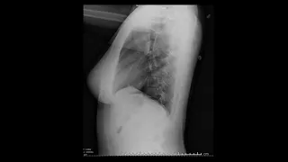 Introduction to Chest Radiography