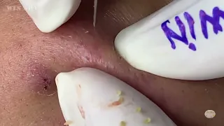 Acne treatment with blackhead removal and pimple popping