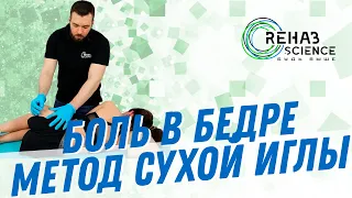 Средняя ягодичная мышца на боку, постановка сухих игл