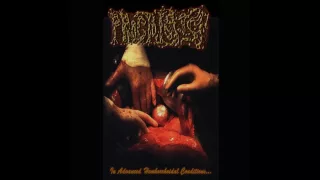 Proctologist - In Advanced Hemhorroidal Conditions EP (2016) Full Album HQ (Goregrind)