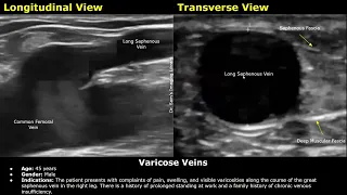 Varicose Veins Doppler Ultrasound Report Example | Lower Limb Venous Insufficiency Sonography USG