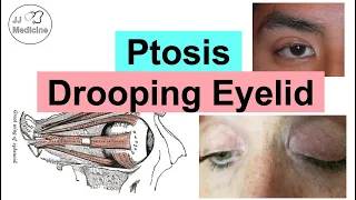 Ptosis (Drooping Eyelid) | Eye Anatomy, Causes, Associated Conditions, Diagnosis & Treatment