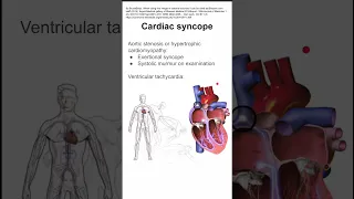 Cardiac syncope