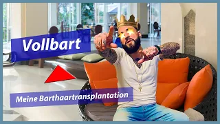 Barthaartransplantation in der Türkei | 4 Monate Post Op Update