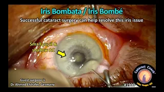 CataractCoach™ 1900: iris bombata / iris bombe - glaucoma