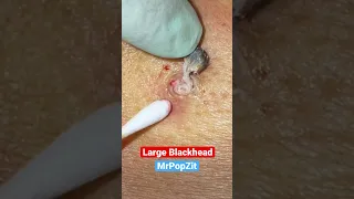 Nice Blackhead plug. See the entire removal on my channel. https://youtu.be/NWqVyjCyh44