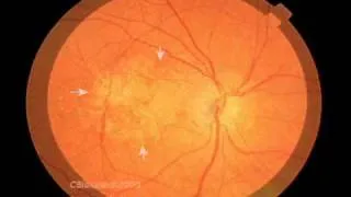 Macular Degeneration and the Aging Retina