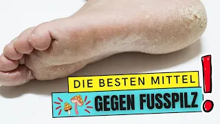 Die besten MITTEL gegen FUSSPILZ! - So wirst du deinen FUSSPILZ endlich los!