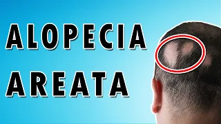 Causes and Treatment of Hair Loss - Alopecia Areata