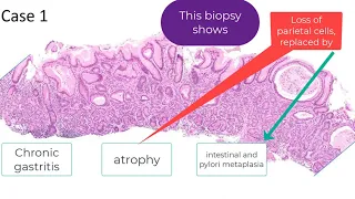 Autoimmune gastritis in 90 seconds