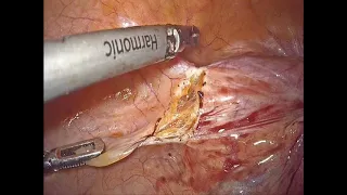 Tricky Bladder Dissection  at TLH