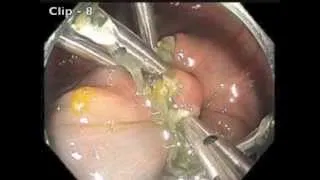 IC valve polyp closure   hemostasis