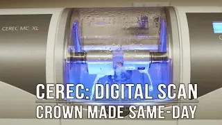 How Dental Crowns are Made with CEREC®