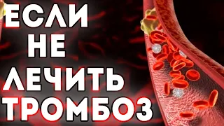 Чем опасен нелеченный тромбоз?