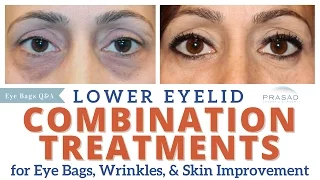 Lower Eyelid Rejuvenation - Treating Eye Bags, Wrinkles, and Darkness with Combination Treatment