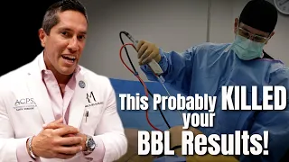 Why My BBL Results Didn't Last, And How You Can AVOID IT!  #bbl