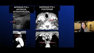 Basics of Parathyroid - MRI Online