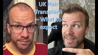 UK Hair Transplant 4 years later.