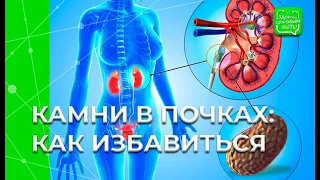 КАМНИ В ПОЧКАХ: Как избавиться?