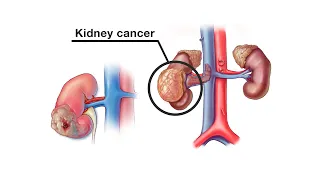 Mayo Clinic Minute - How is kidney cancer treated?