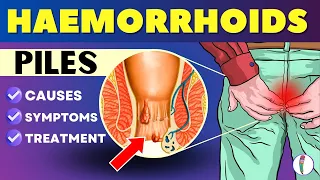 Hemorrhoids (Piles)   Symptoms, Causes, Treatment | Piles problem treatment  | Hemorrhoids symptoms
