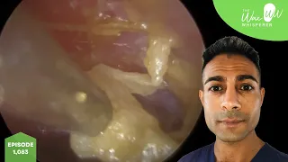 1,083 - Complex Eardrum Perforation Ear Wax Removal