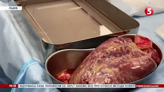 Одразу дві унікальні трансплантації: у Львові лікарі пересадили серце і легені