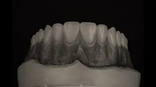 Escultura Gingival y Festoneado en Prostodoncia Total Superior