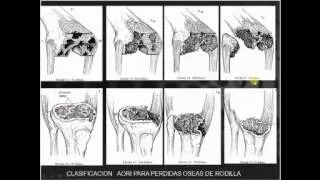 Infecciones Periprotésicas