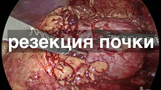 Кобзев: резекция почки