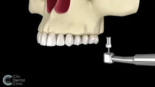 Sinus Lift - surgery before dental implant placement