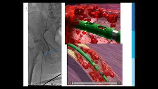 SIR-RFS Webinar (8/13/2018): Venous Thromboembolic Emergencies in the Oncologic Patient