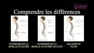Différences: Syndrome de moelle attachée, Syndrome de moelle attachée occulte et Maladie du Filum