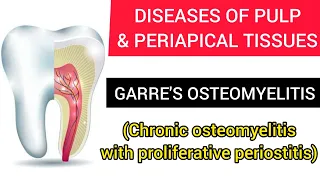 GARRE'S OSTEOMYELITIS (CHRONIC OSTEOMYELITIS WITH PROLIFERATIVE PERIOSTITIS)  {With Bloopers!}