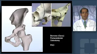 Bernese Periacetabular Osteotomy (PAO) for Correction of Hip Dysplasia