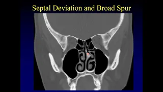 Imaging of the Paranasal Sinuses 2