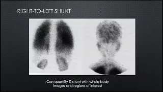 Pulmonary Nuclear medicine