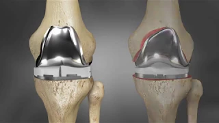 iTotal G2 Knee Implant Fit Animation | Conformis