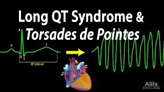 Long QT Syndrome and Torsades de Pointes, Animation