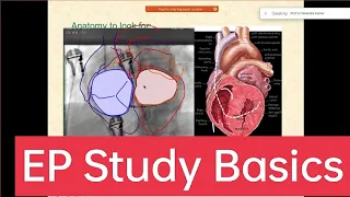 Basics of Cardiac #electrophysiologic study part 1 #epstudy #ablation #SVT #EPS #drnarendrakumar