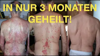 Schuppenflechte - in 3 Monaten geheilt ohne Kortison