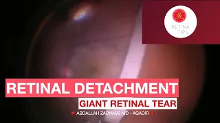 Repair of a retinal detachment associated with Giant retinal tear