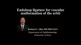 Endoloop ligature for vascular malformation of the orbit